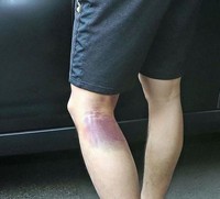 左大腿肉離れ痕